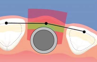 De la Periodoncia a la Implantología y a la Estética Dental