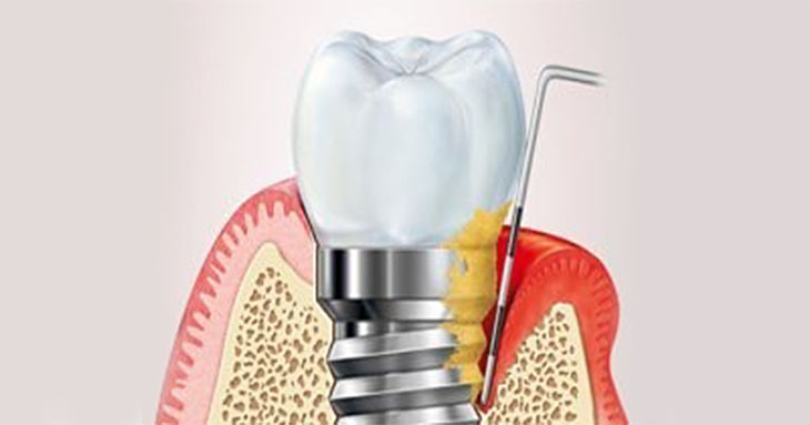 El riesgo de tener perimplantitis