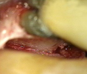 Regeneración Periodontal mínimamente invasiva