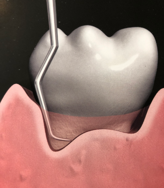 Terapia Periodontal Complementaria