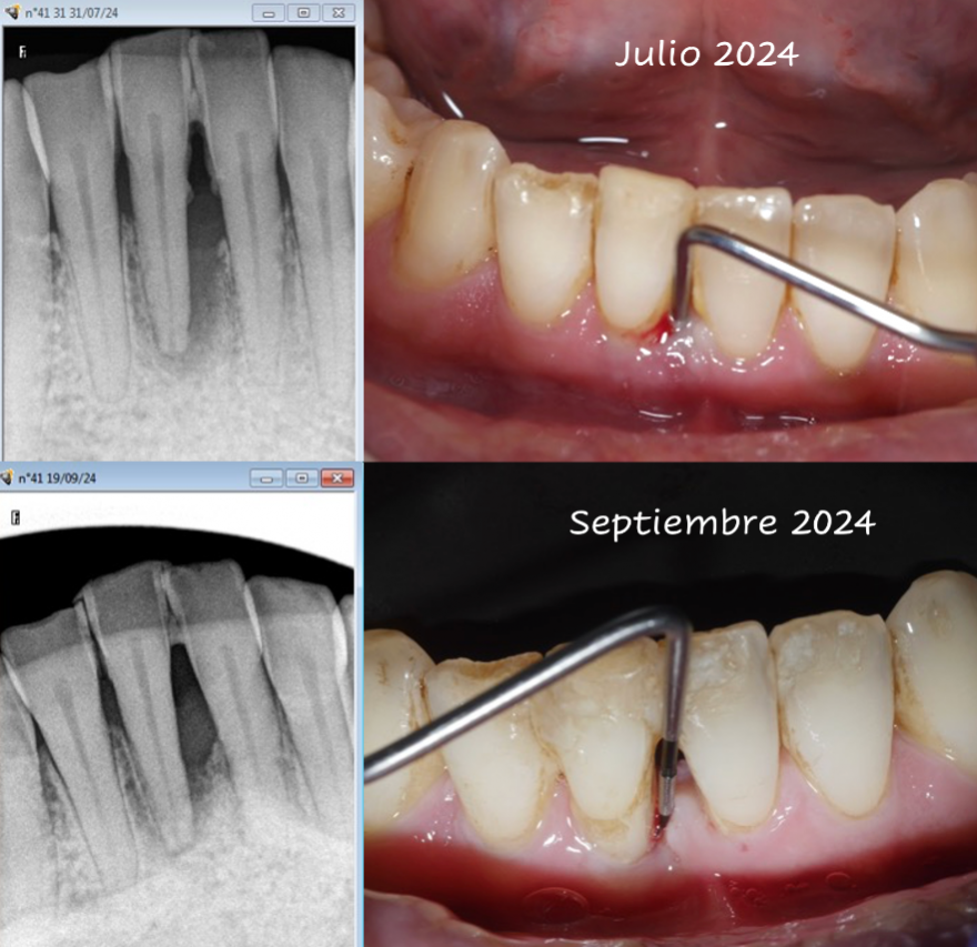 Láser en odontología 